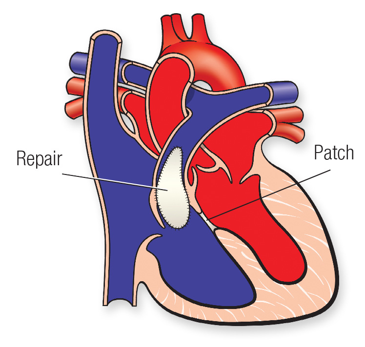 Tetralogy Of Fallot | American Heart Association