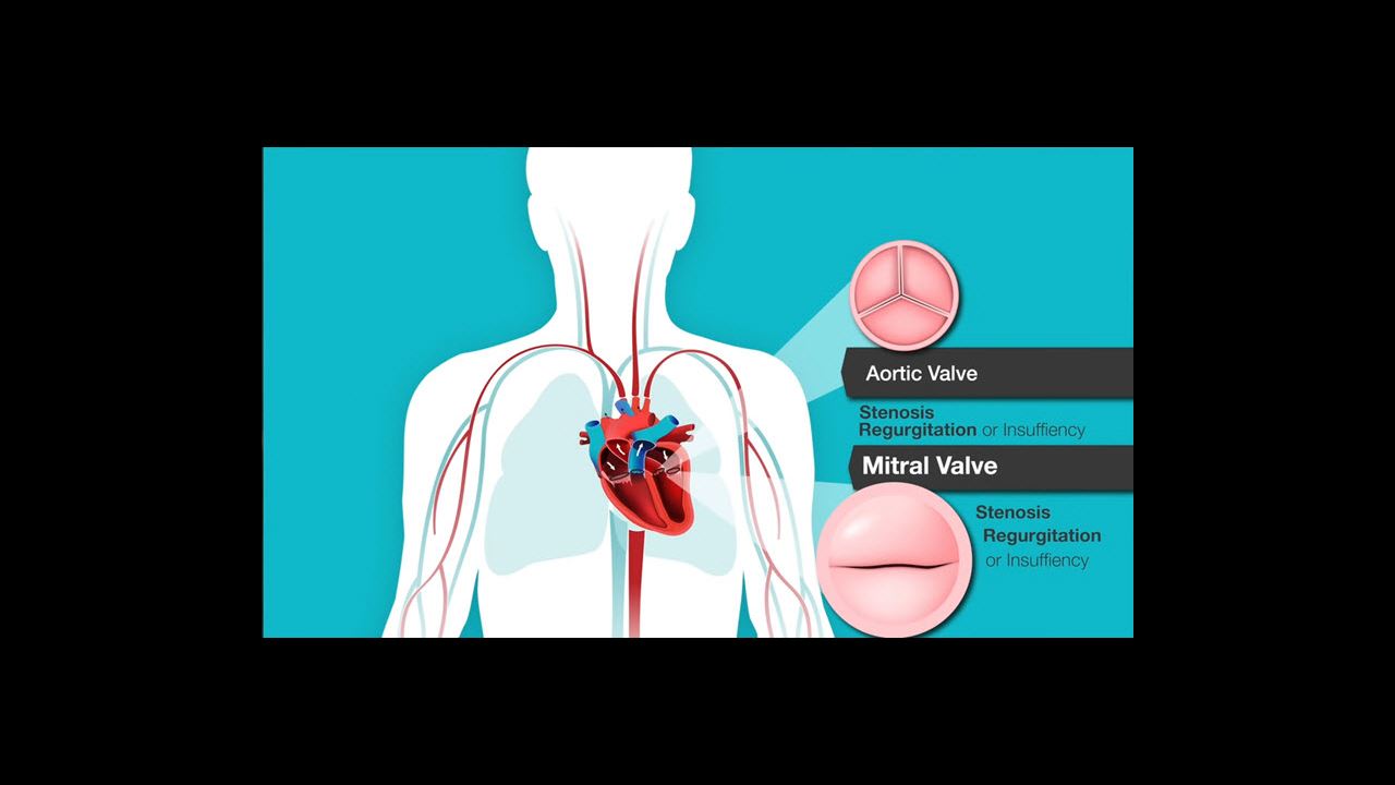 Heart Murmurs And Valve Disease | American Heart Association