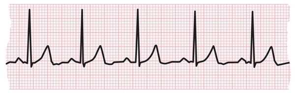 Heart rate during a heart attack: What to know