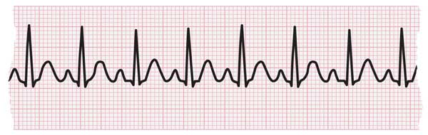 Fast heart rate (tachycardia)