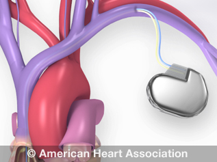 Replacing a pacemaker with a device the width of a human hair