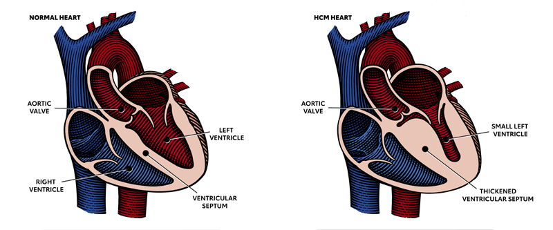 Diagram showing normal heart and one with HCM