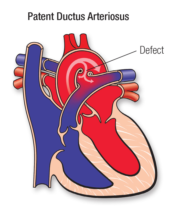 Patent Ductus Arteriosus (PDA) | American Heart Association