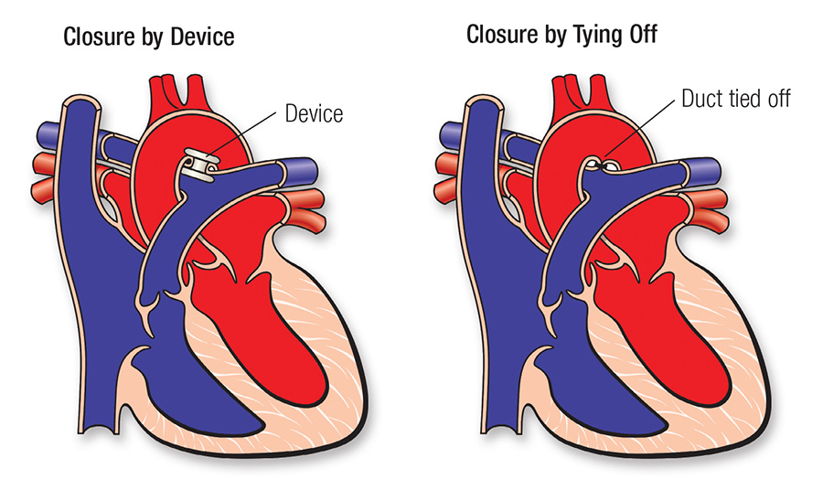 Patent Ductus Arteriosus PDA American Heart Association