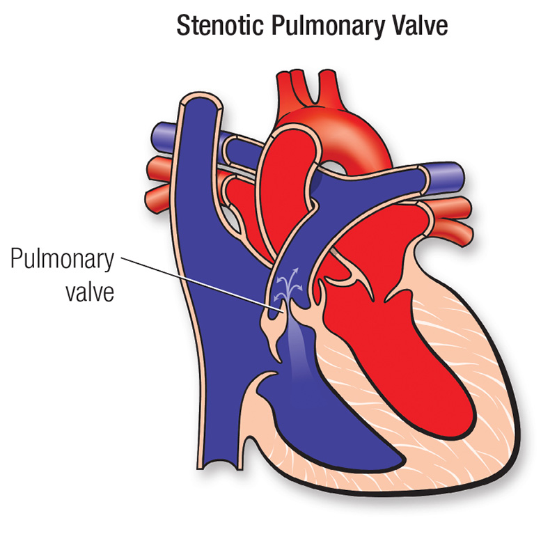 Pulmonary Valve Stenosis American Heart Association