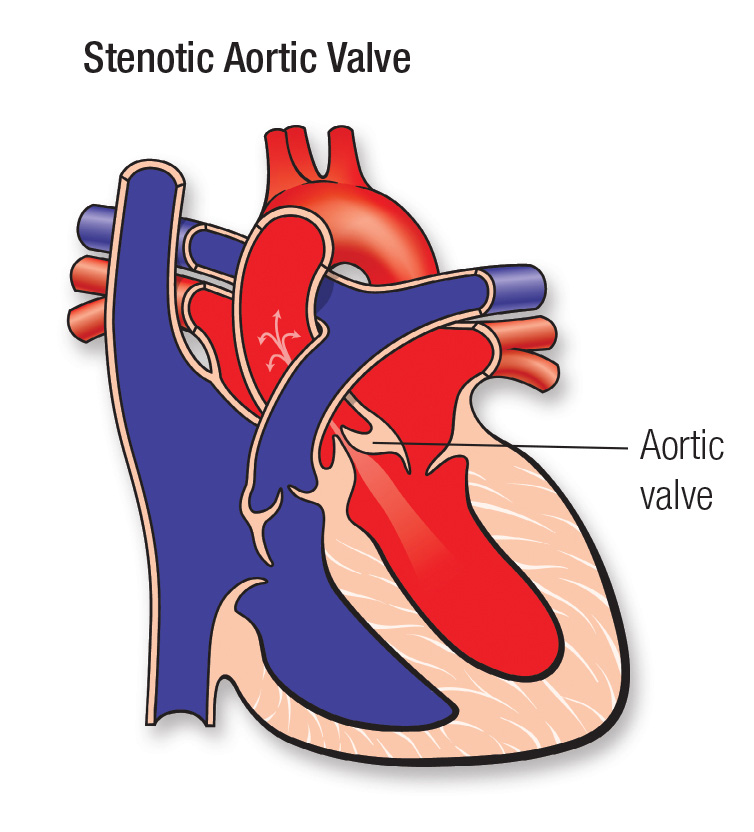 Aortic Valve Stenosis Avs And Congenital Defects American Heart Association