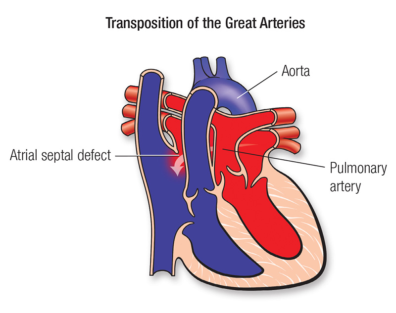d-Transposition of the Great Arteries