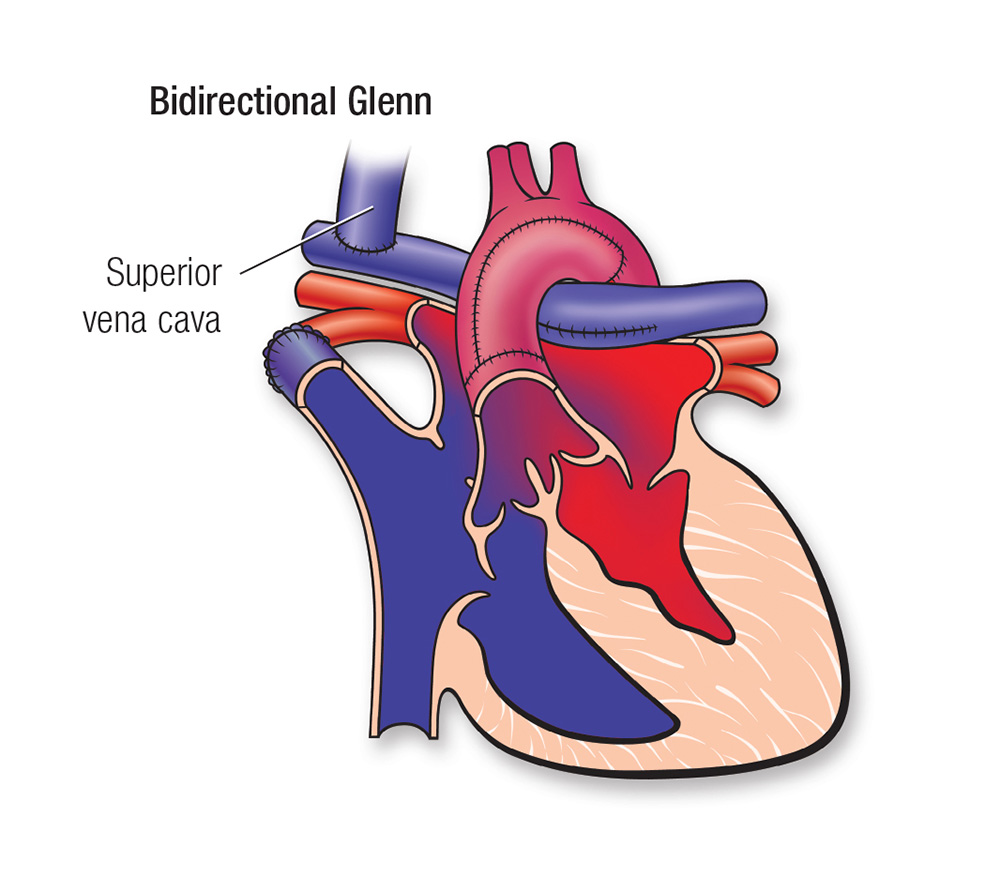 Bi-directional Glenn diagram