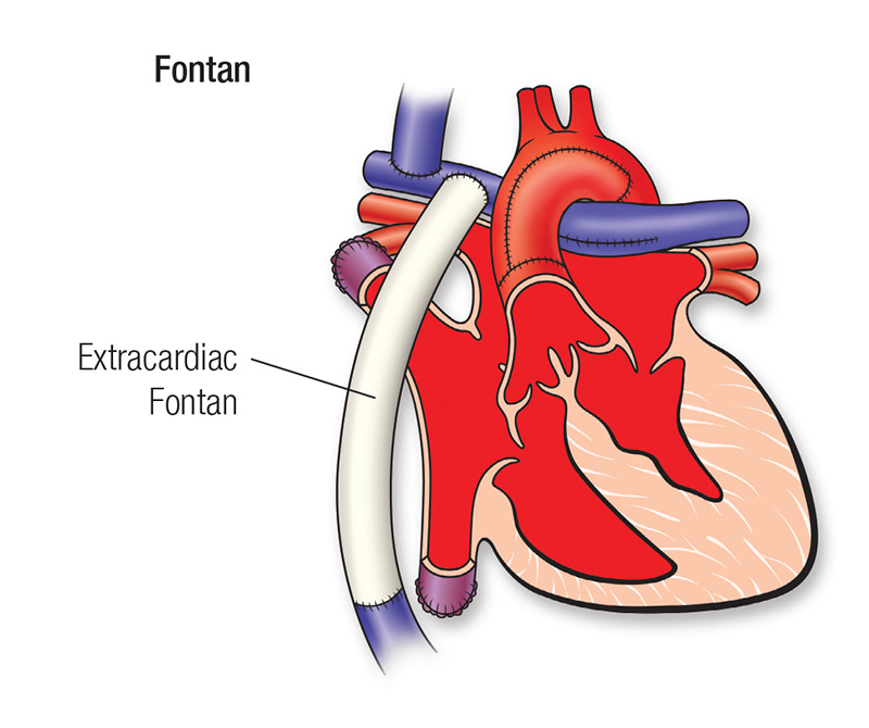 Fontan repair diagram