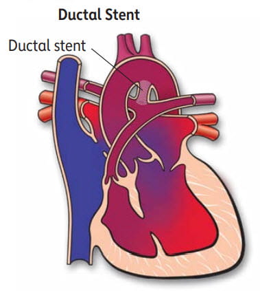 ilustración de un stent