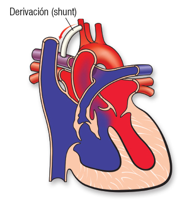 Tetralogy Shunt SP