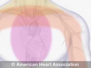 illustration of chest pain