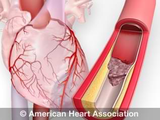 Heart Attack and Sudden Cardiac Arrest Differences