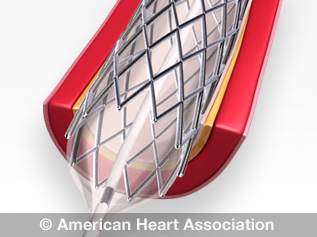 stent in the heart