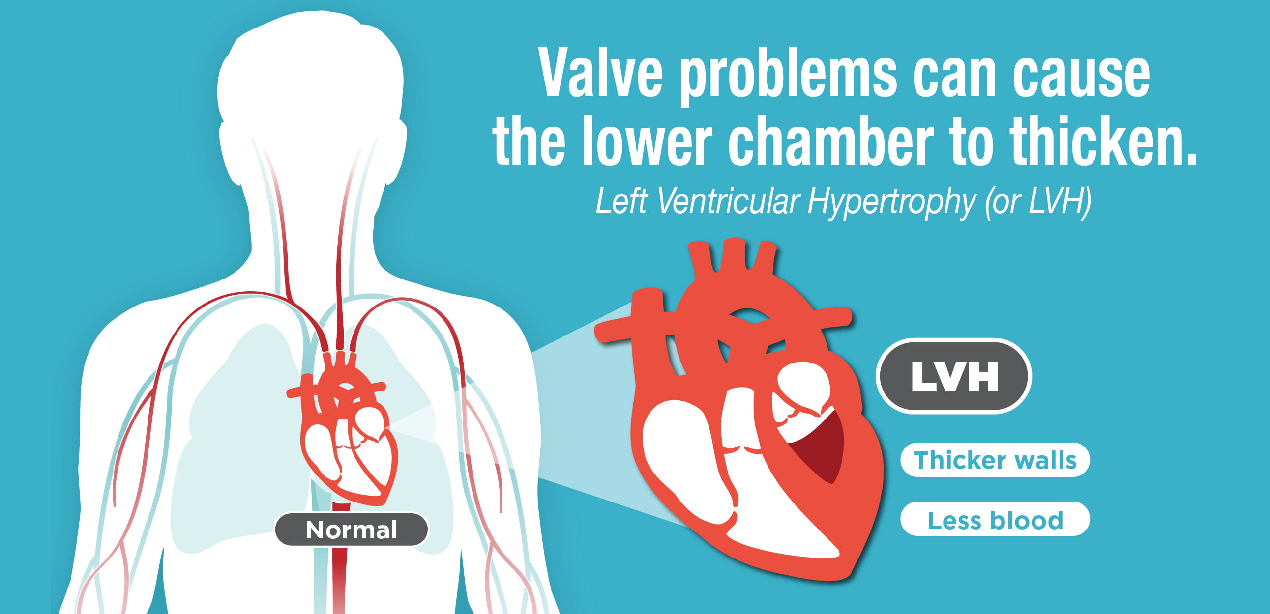 What is Left Ventricular Hypertrophy (LVH)?