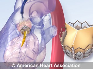cardiac valve replacement