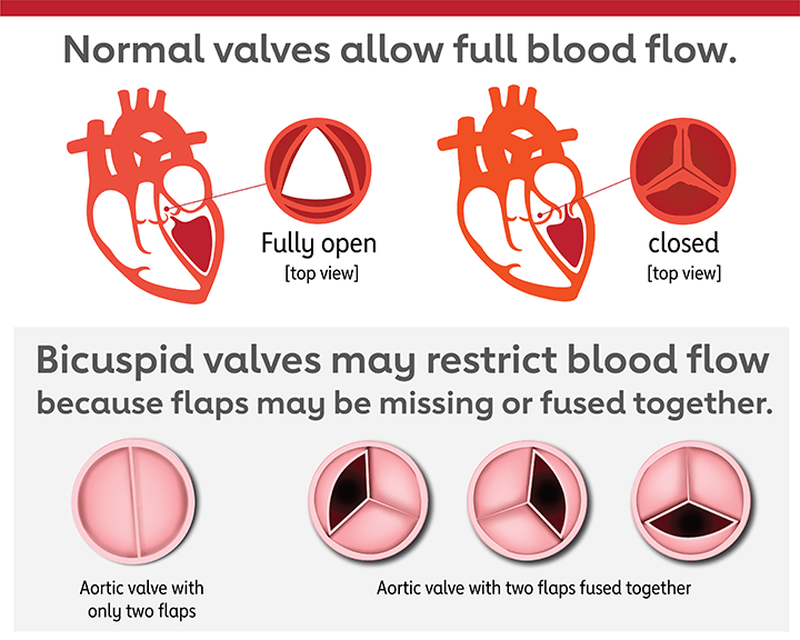 bicuspid aortic valve types