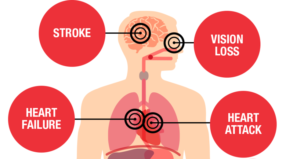 Health Threats from High Blood Pressure | American Heart Association