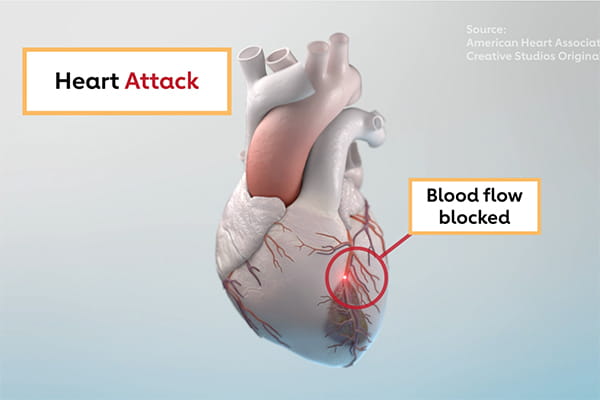 What Is a Heart Attack? - StoryMD