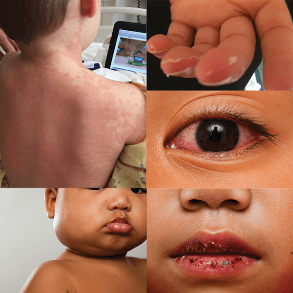 kawasaki disease children