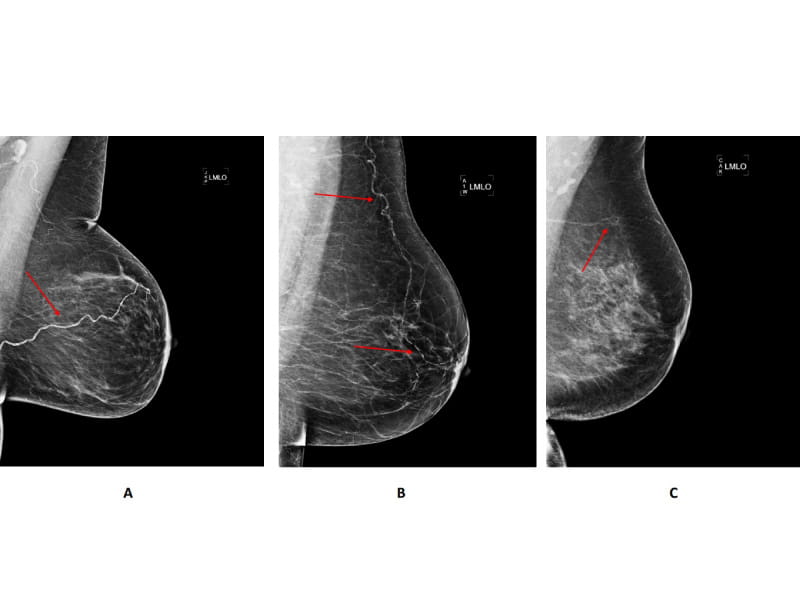 Mammograms may help predict heart disease, stroke risk in women after  menopause