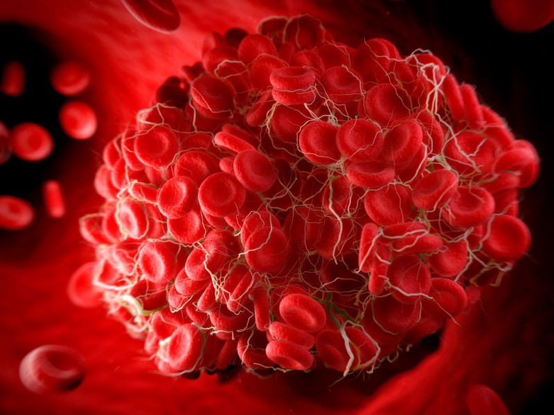 Blood clot risk remains elevated nearly a year after COVID-19