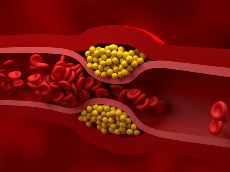 La lipoproteína de baja densidad (LDL), comúnmente conocida como colesterol malo, tiene la capacidad de unirse a grasas y otras sustancias, acumulándose en las paredes internas de las arterias. Esta acumulación puede provocar el estrechamiento y la obstrucción de las arterias, lo que a su vez reduce el flujo sanguíneo. (Nemes Laszlo/Science Photo Library a través de Getty Images)