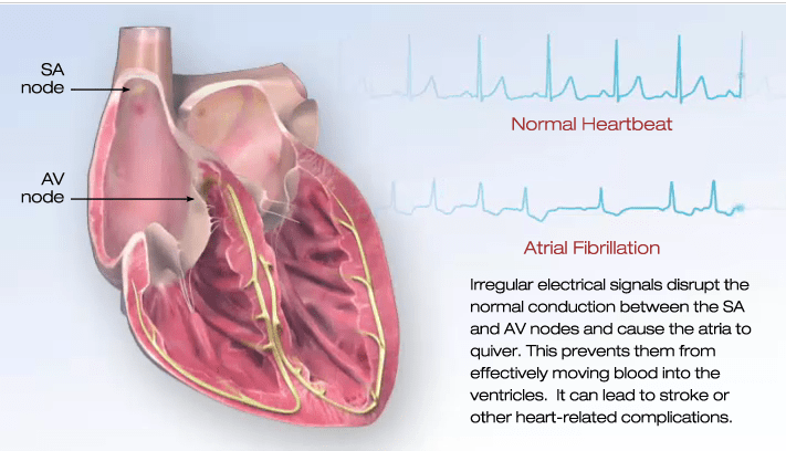 What is AFib?