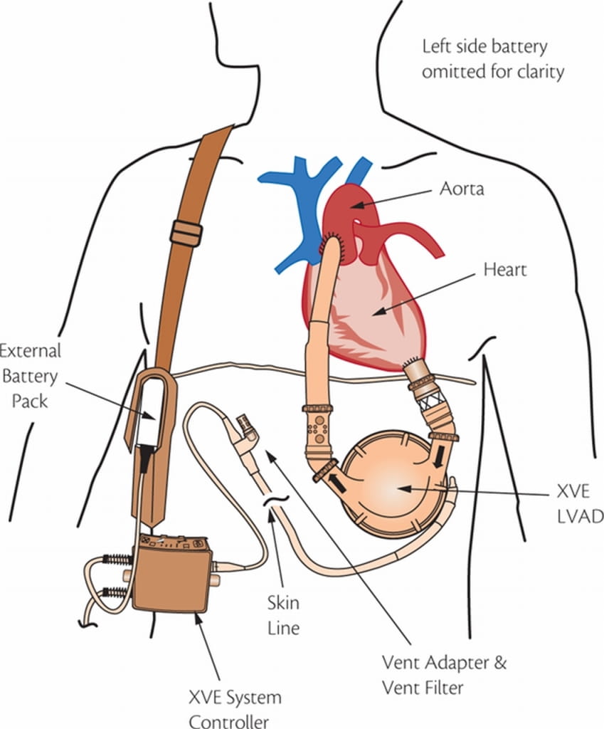 heart battery pack