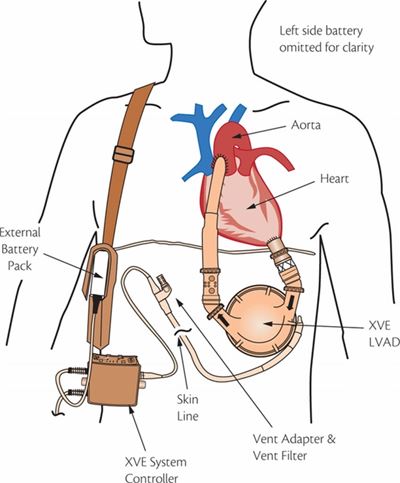 HeartMate XVE in the body. Image courtesy of St. Jude Medical, Inc.