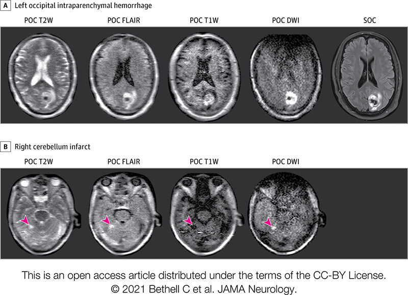 Images of the brain of a COVID-19 patient at Yale taken via portable MRI.