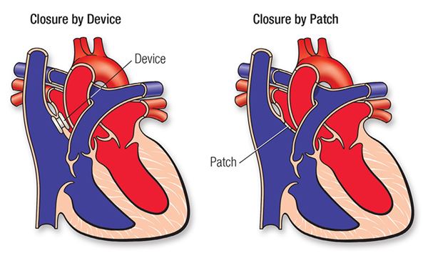 Atrial Septal Defect (ASD) | American Heart Association