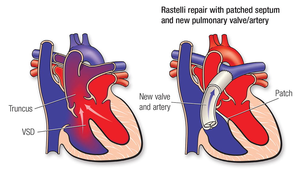 Truncus Arteriosus American Heart Association