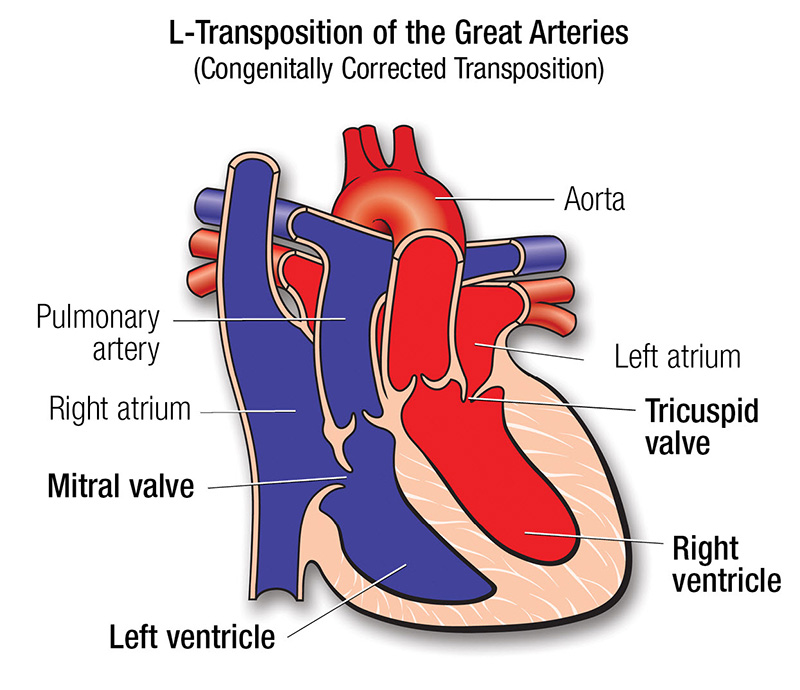 L Transposition Of The Great Arteries American Heart Association