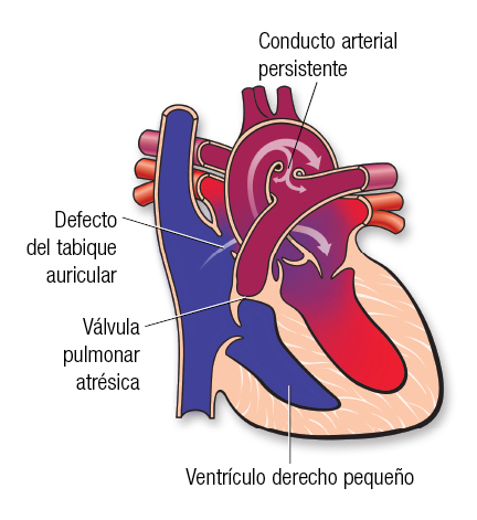 Atresia pulmonar | American Heart Association