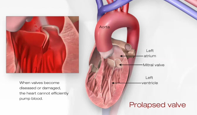 Problem Mitral Valve Prolapse American Heart Association