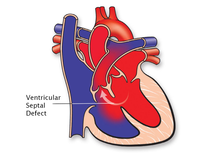 Congenital Heart Disease | American Heart Association