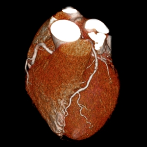 Toshiba Cardiac CTA