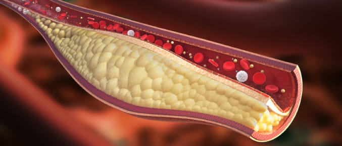 illustration of artery with cholesterol